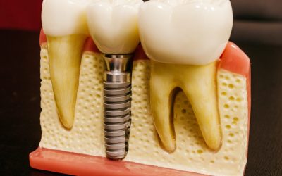 Learn About The Different Parts Of A Dental Implant