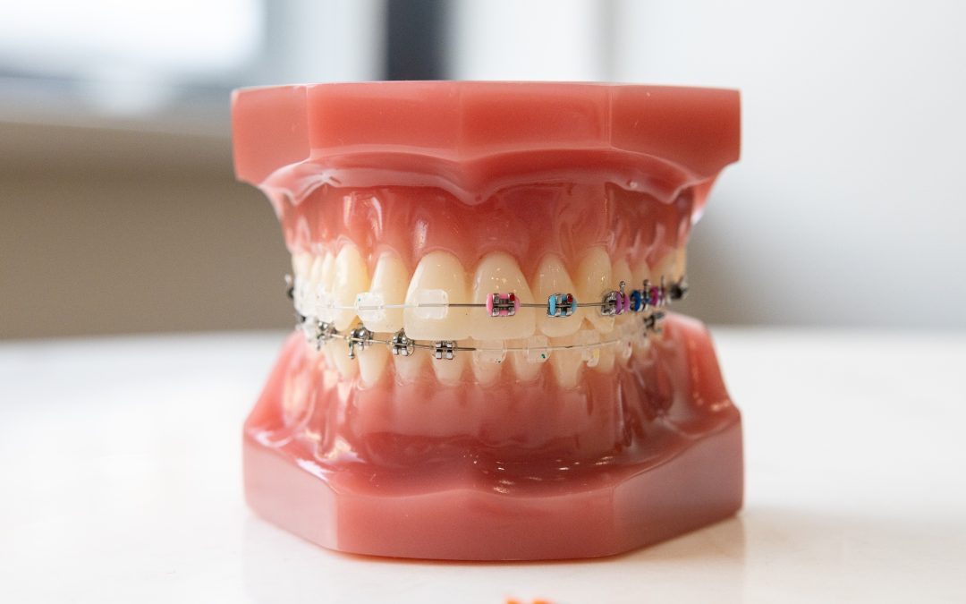 Mouth model displaying how brackets are applied along with the wire to help straighten the teeth.